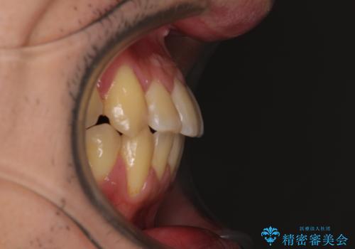 八重歯とクロスバイト　目立たないワイヤー装置で矯正治療の治療後