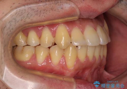 八重歯とクロスバイト　目立たないワイヤー装置で矯正治療の治療後