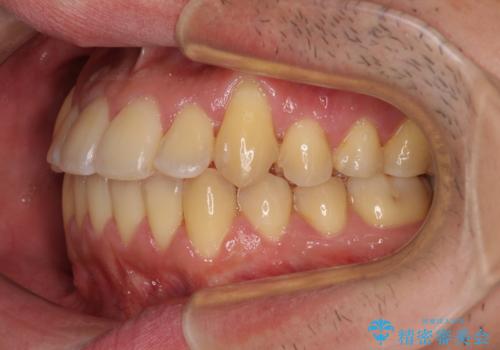 八重歯とクロスバイト 目立たないワイヤー装置で矯正治療の治療後