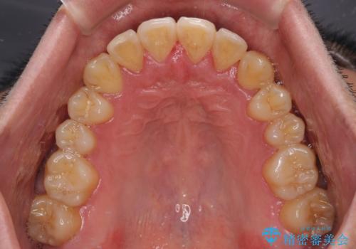 八重歯とクロスバイト 目立たないワイヤー装置で矯正治療の治療後