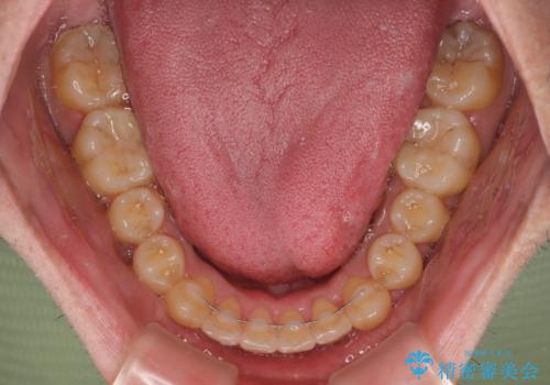 八重歯とクロスバイト 目立たないワイヤー装置で矯正治療の治療後