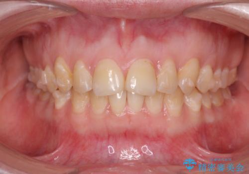 マウスピース矯正で行う出っ歯の治療の治療中