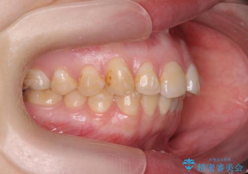 マウスピース矯正で行う出っ歯の治療の治療中