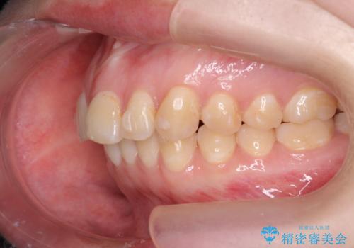 マウスピース矯正で行う出っ歯の治療の治療中