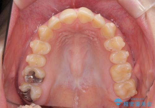 マウスピース矯正で行う出っ歯の治療の治療中