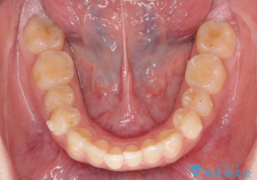 マウスピース矯正で行う出っ歯の治療の治療中