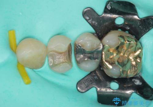 外れてしまった銀歯 セラミックインレーで自然な仕上がりにの治療中