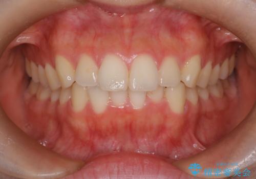 【インビザライン】前歯を下げたいの治療前