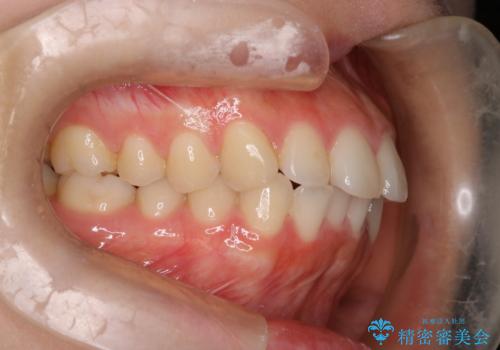 【インビザライン】前歯を下げたいの治療前