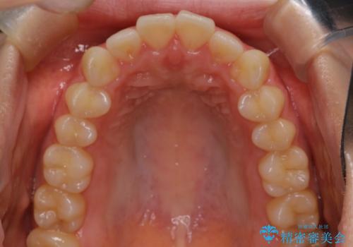 【インビザライン】前歯を下げたいの治療前