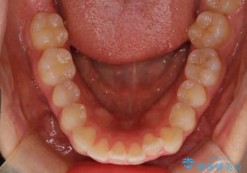【インビザライン】前歯を下げたいの治療前
