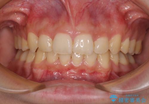 下顎前歯が隠れて突出した口元　ワイヤー装置での抜歯矯正の治療後