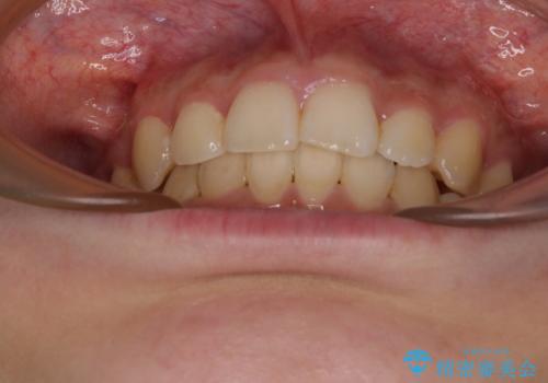 下顎前歯が隠れて突出した口元 ワイヤー装置での抜歯矯正の治療後