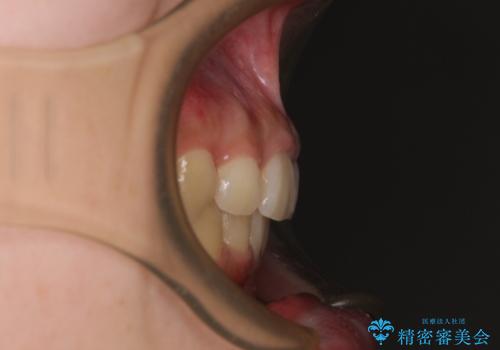 下顎前歯が隠れて突出した口元 ワイヤー装置での抜歯矯正の治療後