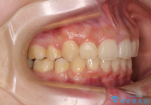 下顎前歯が隠れて突出した口元 ワイヤー装置での抜歯矯正の治療後