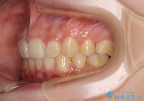 下顎前歯が隠れて突出した口元 ワイヤー装置での抜歯矯正の治療後