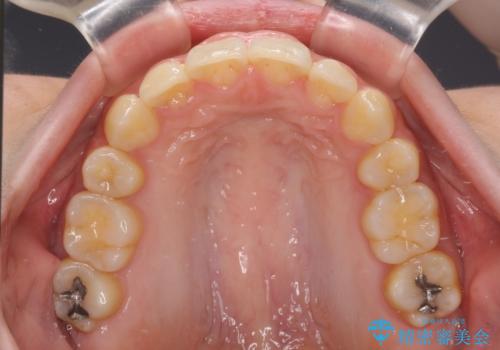 下顎前歯が隠れて突出した口元 ワイヤー装置での抜歯矯正の治療後