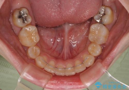 下顎前歯が隠れて突出した口元 ワイヤー装置での抜歯矯正の治療後
