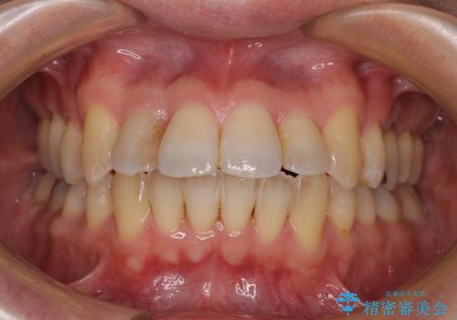 前歯のクロスバイト　目立たないワイヤー装置で矯正治療の治療後