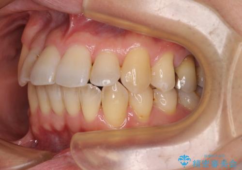 前歯のクロスバイト　目立たないワイヤー装置で矯正治療の治療後