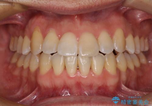 左右の八重歯が気になる　ワイヤー装置での咬み合わせ改善の症例 治療後