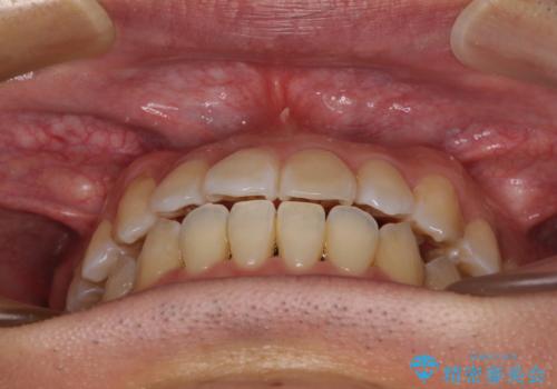 左右の八重歯が気になる　ワイヤー装置での咬み合わせ改善の治療後
