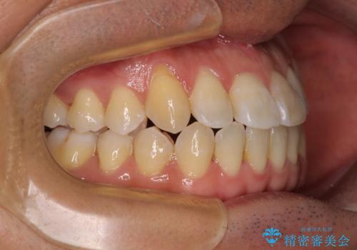 左右の八重歯が気になる ワイヤー装置での咬み合わせ改善の治療後