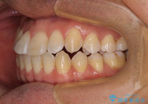 左右の八重歯が気になる ワイヤー装置での咬み合わせ改善の治療後