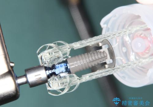 【インプラント】 他院で入れた被せ物が取れたの治療中