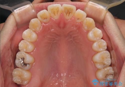 左右の八重歯が気になる ワイヤー装置での咬み合わせ改善の治療後