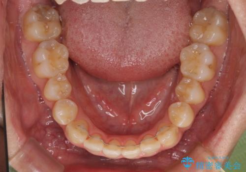 左右の八重歯が気になる　ワイヤー装置での咬み合わせ改善の治療後