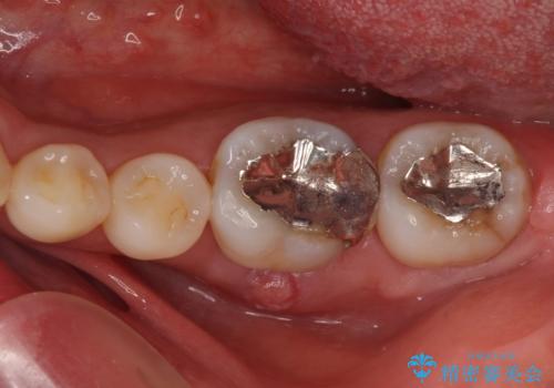 むし歯で歯茎から血が出てくる　オールセラミッククラウンでの補綴治療の症例 治療前