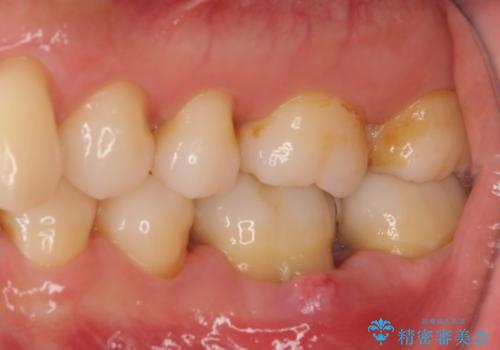 むし歯で歯茎から血が出てくる オールセラミッククラウンでの補綴治療の治療前