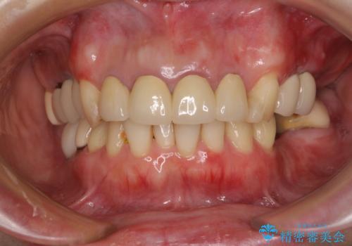 仮歯のまま放置した前歯　オールセラミッククラウンで自然な前歯にの治療後