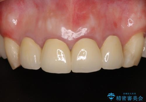 仮歯のまま放置した前歯 オールセラミッククラウンで自然な前歯にの治療後