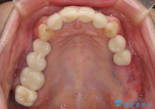 仮歯のまま放置した前歯 オールセラミッククラウンで自然な前歯にの治療後