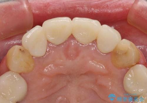 仮歯のまま放置した前歯 オールセラミッククラウンで自然な前歯にの治療後