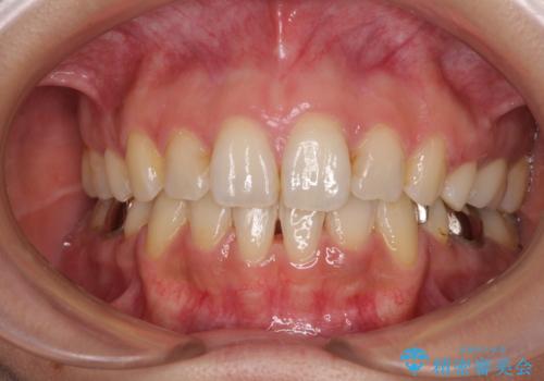 デコボコと口元の突出感　ハーフリンガルでの抜歯矯正の症例 治療後
