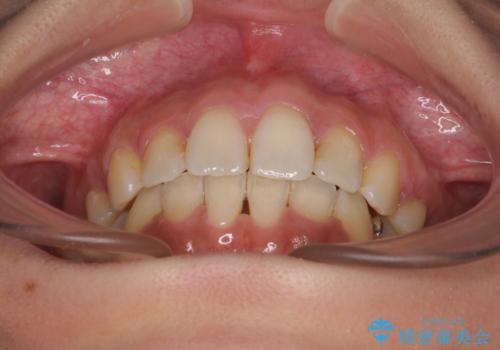 デコボコと口元の突出感 ハーフリンガルでの抜歯矯正の治療後
