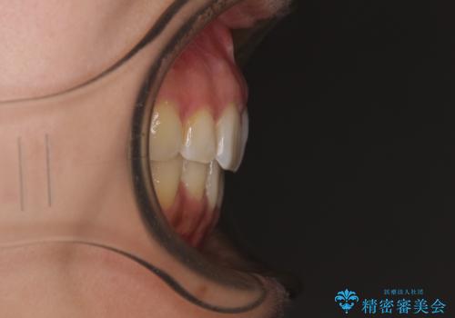 デコボコと口元の突出感 ハーフリンガルでの抜歯矯正の治療後