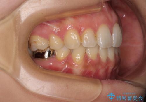 デコボコと口元の突出感　ハーフリンガルでの抜歯矯正の治療後