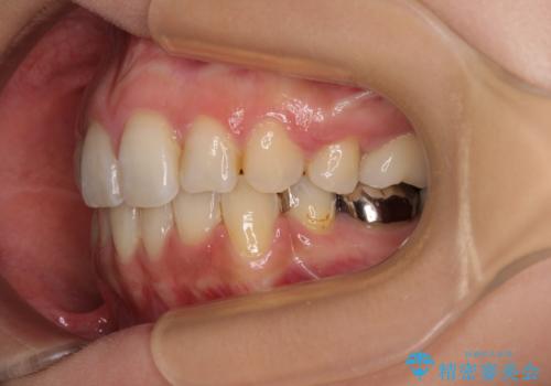 デコボコと口元の突出感 ハーフリンガルでの抜歯矯正の治療後