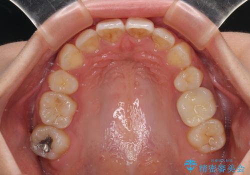 デコボコと口元の突出感 ハーフリンガルでの抜歯矯正の治療後