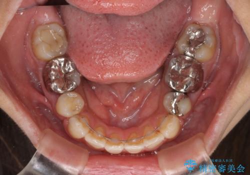 デコボコと口元の突出感 ハーフリンガルでの抜歯矯正の治療後