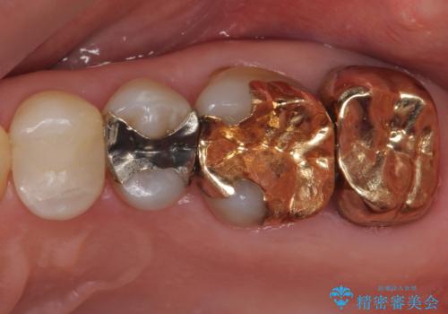 外れてしまった銀歯 セラミックインレーで自然な仕上がりにの治療後