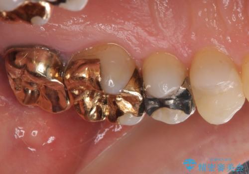外れてしまった銀歯 セラミックインレーで自然な仕上がりにの治療後