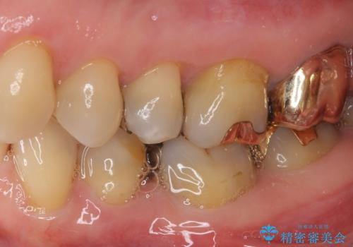 外れてしまった銀歯 セラミックインレーで自然な仕上がりにの治療後
