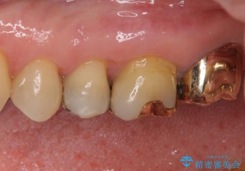 外れてしまった銀歯 セラミックインレーで自然な仕上がりにの治療後