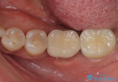しみる奥歯 オールセラミッククラウンによる補綴治療の症例 治療後