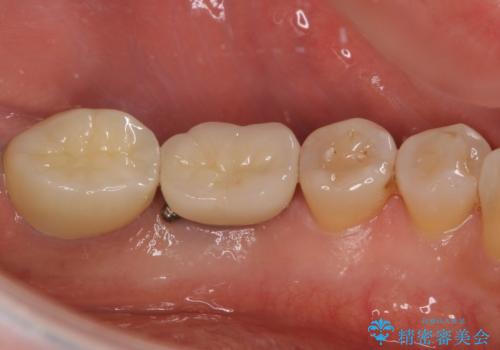 しみる奥歯 オールセラミッククラウンによる補綴治療の治療後
